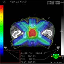 Prostate Cancer Treatment • Image Guided Radiation Therapy