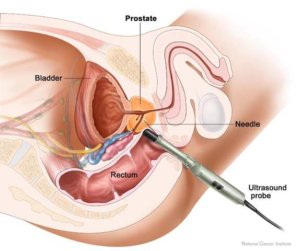 Prostate Ultrasound Illustration